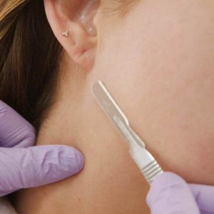 Dermaplaning